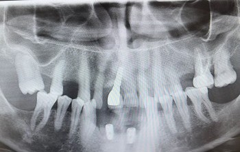 Engelli şehit ve Gazilere Diş İmplant tedavisi