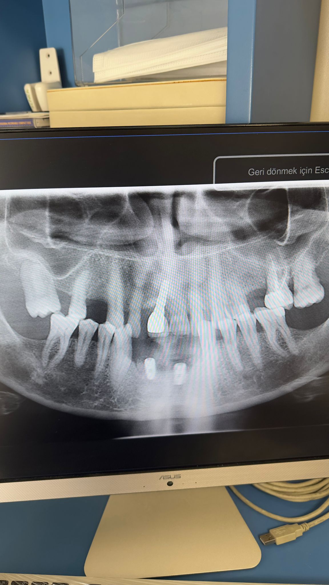 Engelli şehit ve Gazilere Diş İmplant tedavisi
