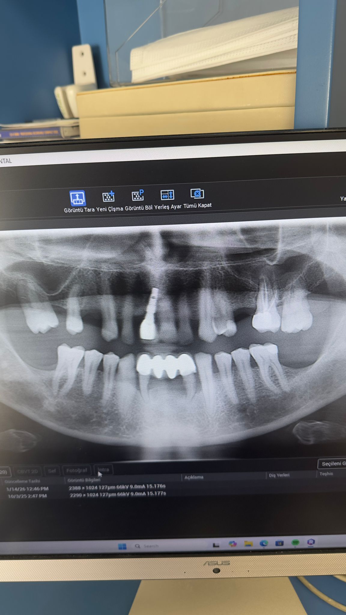Engelli şehit ve Gazilere Diş İmplant tedavisi