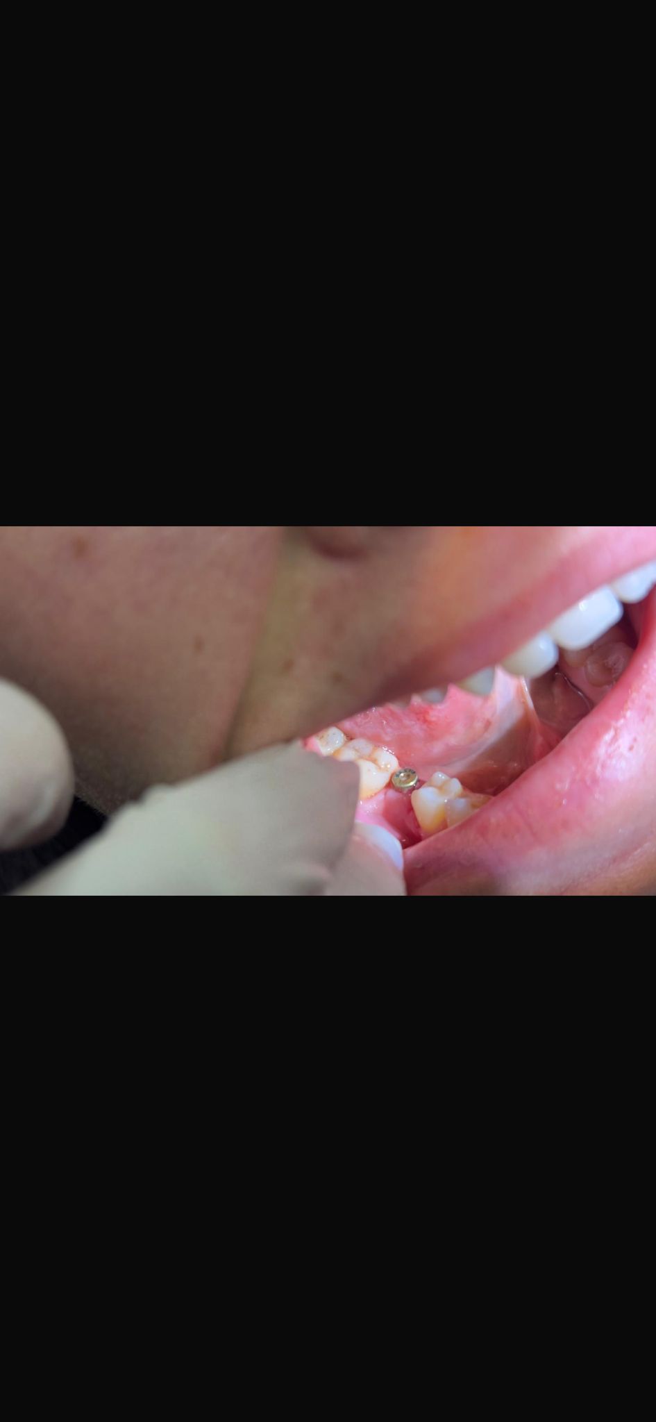 Engelli şehit ve Gazilere Diş İmplant tedavisi