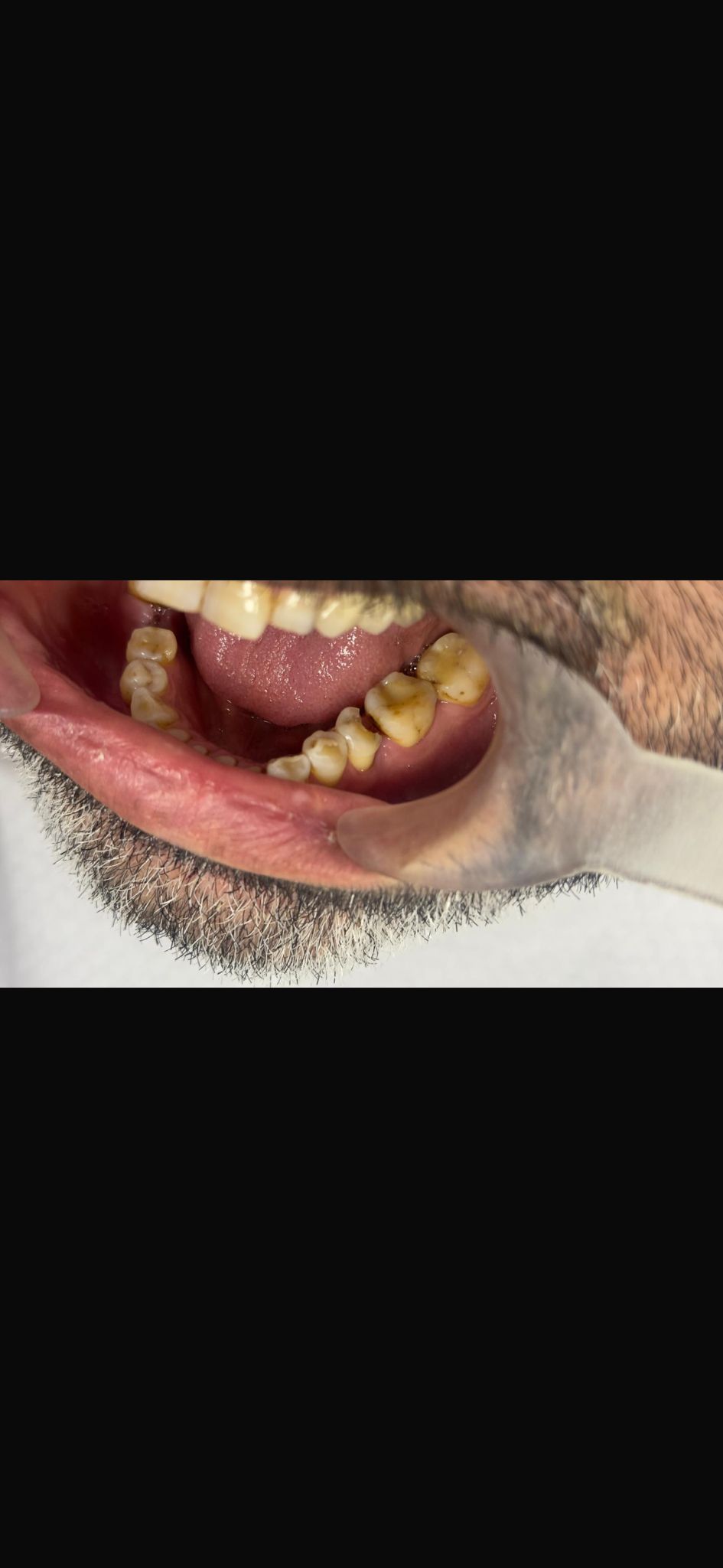 Engelli şehit ve Gazilere Diş İmplant tedavisi