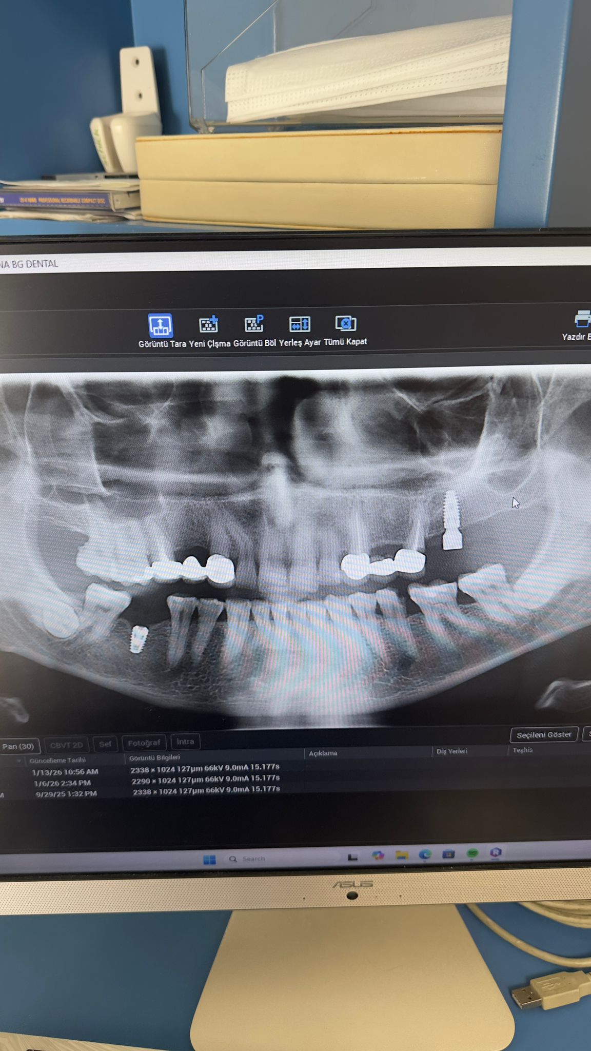 Engelli şehit ve Gazilere Diş İmplant tedavisi